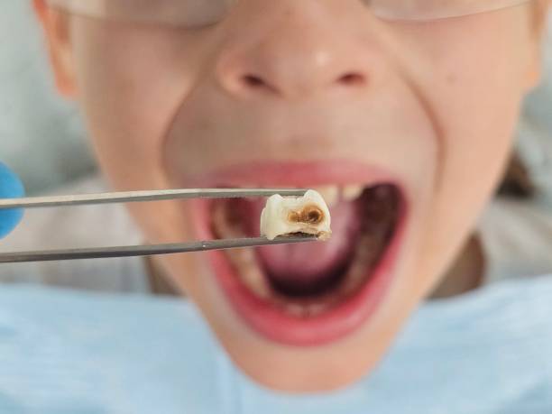 Best Emergency Dentist for Lost Fillings or Crowns in Montpelier, OH