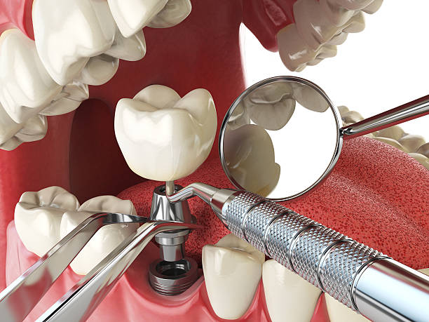 Best Emergency Dentist for Knocked-Out Tooth in Montpelier, OH